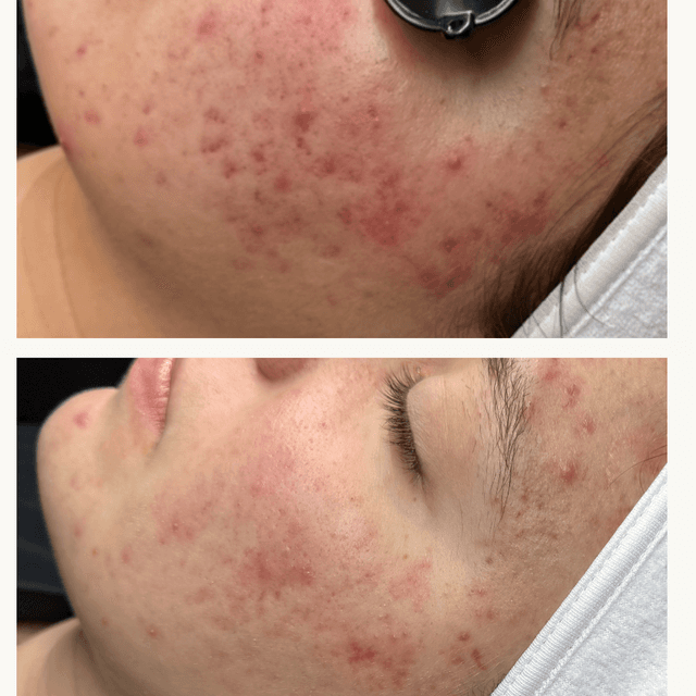 Acne bootcamp at Cristal Clear Aesthetics in Reno, NV
